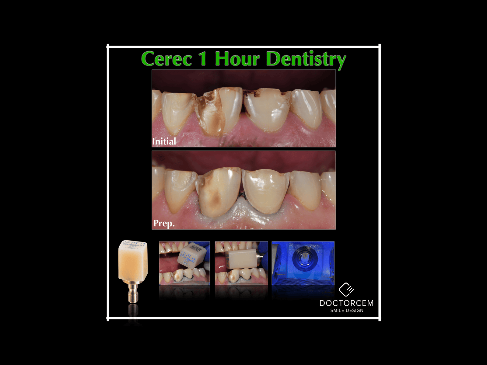 Cerec 1 Hour Dentistry